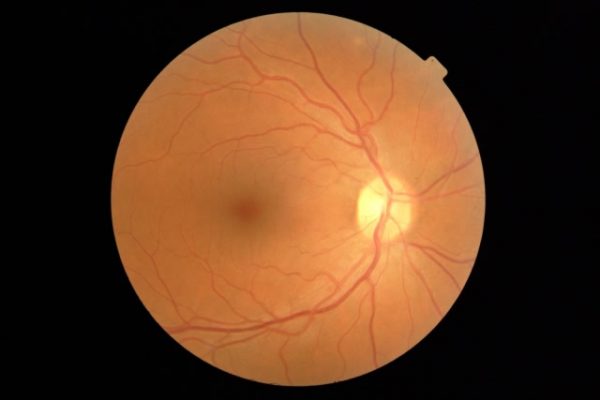 Retinografía en Optica CLiment Valencia